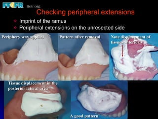 Checking peripheral extensions Imprint of the ramus Peripheral extensions on the unresected side Periphery wax applied Pattern after removal Note displacement of tissues anteriorly A good pattern Tissue displacement in the posterior lateral area 