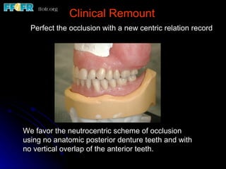 Clinical Remount Perfect the occlusion with a new centric relation record We favor the neutrocentric scheme of occlusion using no anatomic posterior denture teeth and with no vertical overlap of the anterior teeth. 