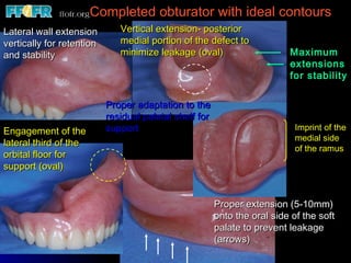 Completed obturator with ideal contours   Lateral wall extension vertically for retention and stability Proper adaptation to the residual palatal shelf for support Engagement of the lateral third of the orbital floor for support (oval) Imprint of the medial side of the ramus Vertical extension- posterior medial portion of the defect to minimize leakage (oval) Maximum extensions  for stability Proper extension (5-10mm) onto the oral side of the soft palate to prevent leakage (arrows) 