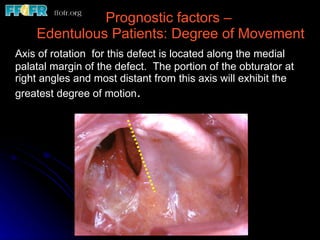 Prognostic factors –  Edentulous Patients: Degree of Movement Axis of rotation  for this defect is located along the medial palatal margin of the defect.  The portion of the obturator at right angles and most distant from this axis will exhibit the greatest degree of motion .  