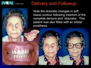 Delivery and Followup Note the dramatic changes in soft tissue contour following insertion of the complete denture and  obturator.  This patient was also fitted with an orbital prosthesis.  