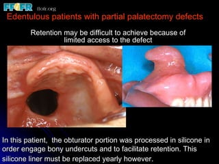 Edentulous patients with partial palatectomy defects Retention may be difficult to achieve because of limited access to the defect In this patient,  the obturator portion was processed in silicone in order engage bony undercuts and to facilitate retention. This silicone liner must be replaced yearly however . 