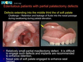 Relatively small partial maxillectomy defect.  It is difficult to engage such defects and implants are recommended to enhance retention.  Nasal side of soft palate engaged to enhance seal (arrow). Edentulous patients with partial palatectomy defects Defects extending into the middle third the of soft palate Challenge – Retention and leakage of fluids into the nasal passage during swallowing during palatal elevation. 