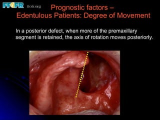 Prognostic factors –  Edentulous Patients: Degree of Movement In a posterior defect, when more of the premaxillary segment is retained, the axis of rotation moves posteriorly. 