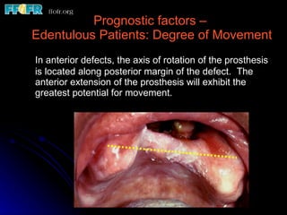 Prognostic factors –  Edentulous Patients: Degree of Movement In anterior defects, the axis of rotation of the prosthesis is located along posterior margin of the defect.  The anterior extension of the prosthesis will exhibit the greatest potential for movement. 