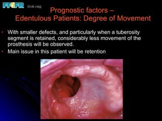 Prognostic factors –  Edentulous Patients: Degree of Movement With smaller defects, and particularly when a tuberosity segment is retained, considerably less movement of the prosthesis will be observed. Main issue in this patient will be retention  