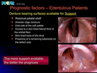 Prognostic factors – Edentulous Patients   Denture bearing surfaces available for   Support Residual palatal shelf Alveolar ridge contours Oral side of the soft palate Access to a skin lined lateral third of  the orbital floor Skin lined base of the skull Presence of a remaining tuberosity on    the defect side The more support available the better the prognosis 