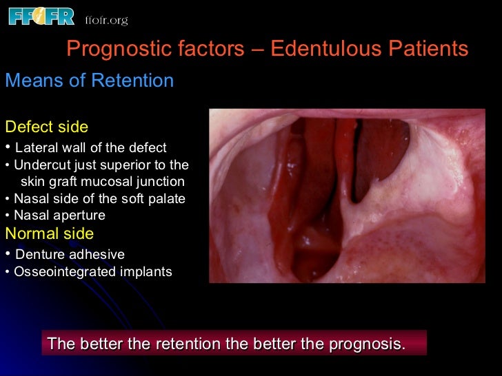 edentulous patients