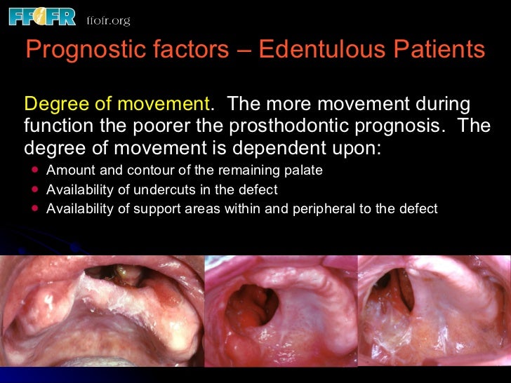 edentulous patients