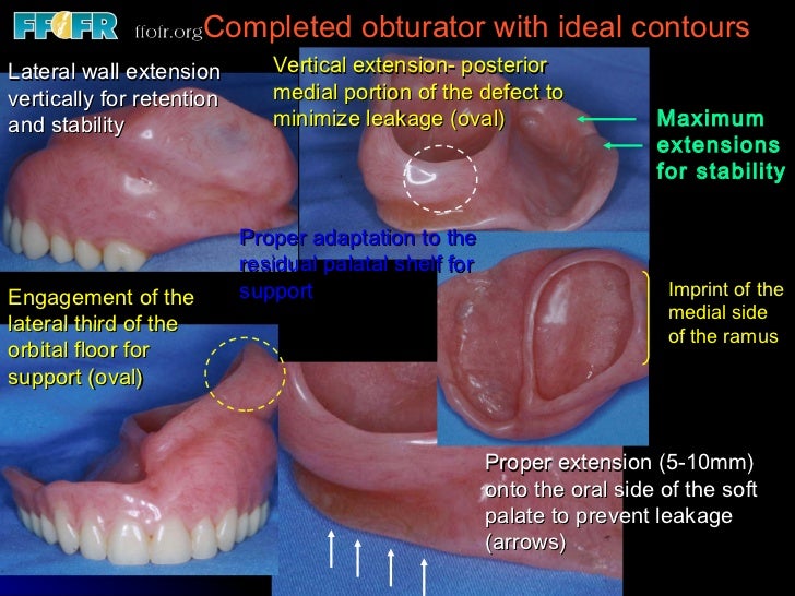 Definitive obturators edentulous patients