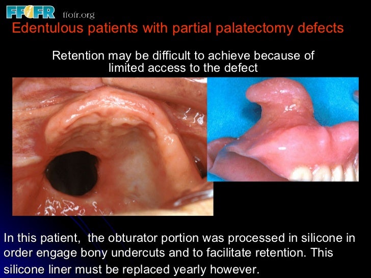 edentulous patients
