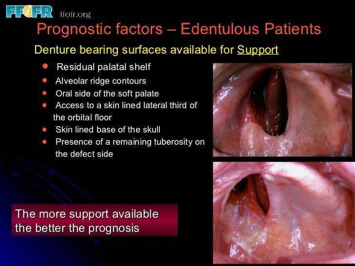 edentulous patients