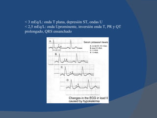 < 3 mEq/L: onda T plana, depresión ST, ondas U
< 2,5 mEq/L: onda Uprominente, inversión onda T, PR y QT
prolongado, QRS ensanchado
 