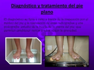 Diagnóstico y tratamiento del pie
plano
El diagnóstico se lleva a cabo a través de la inspección por el
médico del pie y la realización de unas radiografías y una
podografía- estudio de la huella de la planta del pie- que
permiten establecer varios grados según la gravedad.
 