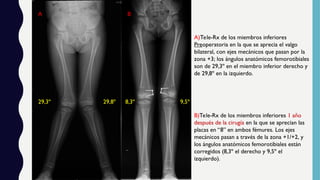 DEFORMIDADES GENU VARO Y GENU VALGO COMPLETA.ppt