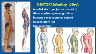 SIMPTOMI kifotičnog držanja:
Antefleksija trupa (arcus posterior)
Glava spuštena prema grudima
Ramena savijena prema napred
Uvučen gruni koš
Ispupčen trbuh
 