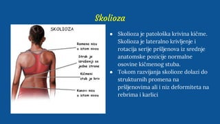 Skolioza
● Skolioza je patološka krivina kičme.
Skolioza je lateralno krivljenje i
rotacija serije pršljenova iz srednje
anatomske pozicije normalne
osovine kičmenog stuba.
● Tokom razvijanja skolioze dolazi do
strukturnih promena na
pršljenovima ali i niz deformiteta na
rebrima i karlici
 