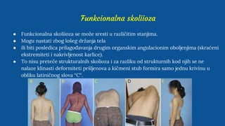 Funkcionalna skoliioza
● Funkcionalna skoliioza se može sresti u različitim stanjima.
● Mogu nastati zbog lošeg držanja tela
● ili biti posledica prilagođavanja drugim organskim angulacionim oboljenjima (skraćeni
ekstremiteti i nakrivljenost karlice).
● To nisu preteče strukturalnih skolioza i za razliku od strukturnih kod njih se ne
nalaze klinasti deformiteti pršljenova a kičmeni stub formira samo jednu krivinu u
obliku latiničnog slova “C“.
 