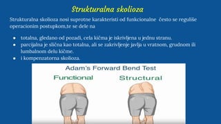 Strukturalna skolioza
Strukturalna skolioza nosi suprotne karakteristi od funkcionalne često se reguliše
operacionim postupkom,te se dele na
● totalna, gledano od pozadi, cela kičma je iskrivljena u jednu stranu.
● parcijalna je slična kao totalna, ali se zakrivljenje javlja u vratnom, grudnom ili
lumbalnom delu kičme.
● i kompenzatorna skolioza.
 
