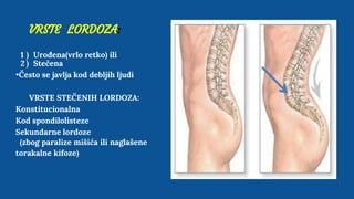 VRSTE LORDOZA:
1 ) Urođena(vrlo retko) ili
2 ) Stečena
•Često se javlja kod debljih ljudi
VRSTE STEČENIH LORDOZA:
Konstitucionalna
Kod spondilolisteze
Sekundarne lordoze
(zbog paralize mišića ili naglašene
torakalne kifoze)
 