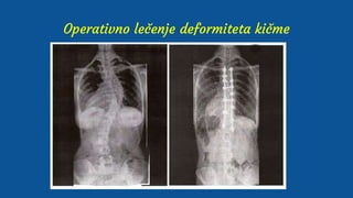 Operativno lečenje deformiteta kičme
 