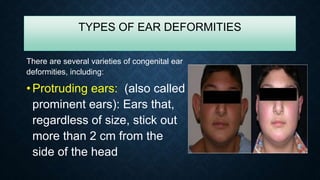 TYPES OF EAR DEFORMITIES
There are several varieties of congenital ear
deformities, including:
• Protruding ears: (also called
prominent ears): Ears that,
regardless of size, stick out
more than 2 cm from the
side of the head
 