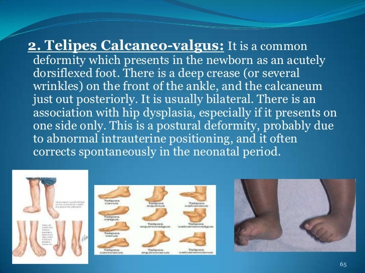Deformities Of Human Body