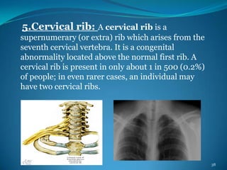 Neck Rib Defect Deformities of human body pps | PPSX