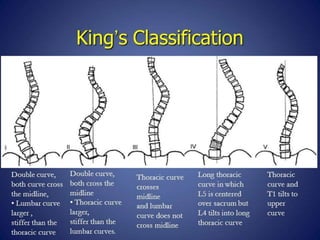 Deformities of spine | PPTX