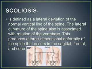 Deformities of spine | PPTX
