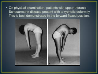 Deformities of spine | PPTX