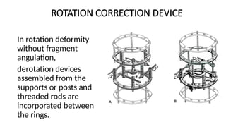 Comprehensive Guide to Deformity Correction Using Hinges and Osteotomy ...