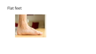 Flat feet
 