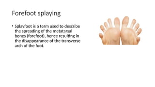 Forefoot splaying
• Splayfoot is a term used to describe
the spreading of the metatarsal
bones (forefoot), hence resulting in
the disappearance of the transverse
arch of the foot.
 