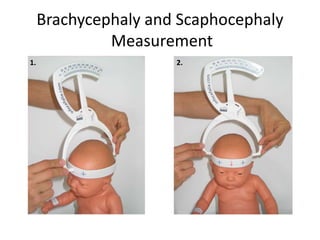 Plagiocephaly Measurement With Craniometer Diagnosis Prevention 