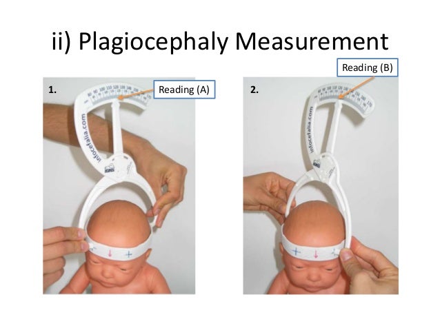 plagiocephaly measurement with craniometer diagnosis prevention
