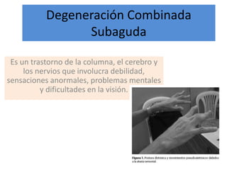 Degeneración Combinada
Subaguda
Es un trastorno de la columna, el cerebro y
los nervios que involucra debilidad,
sensaciones anormales, problemas mentales
y dificultades en la visión.
 