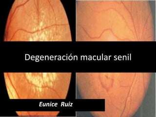 Degeneración macular senil
Eunice Ruiz
 