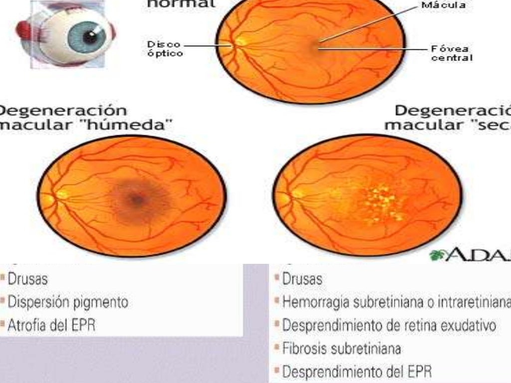 Degeneracion macular senil
