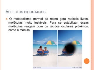 Aspectos bioquímicosO metabolismo normal da retina gera radicais livres, moléculas muito instáveis. Para se estabilizar, essas moléculas reagem com os tecidos oculares próximos, como a mácula.