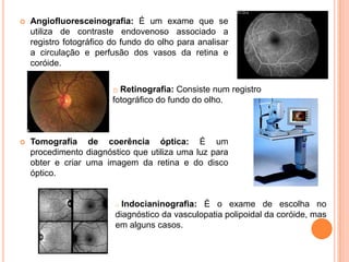 Angiofluoresceinografia: É um exame que se utiliza de contraste endovenoso associado a registro fotográfico do fundo do olho para analisar a circulação e perfusão dos vasos da retina e coróide.Tomografia de coerência óptica: É um procedimento diagnóstico que utiliza uma luz para obter e criar uma imagem da retina e do disco óptico.Retinografia: Consiste num registro   fotográfico do fundo do olho.