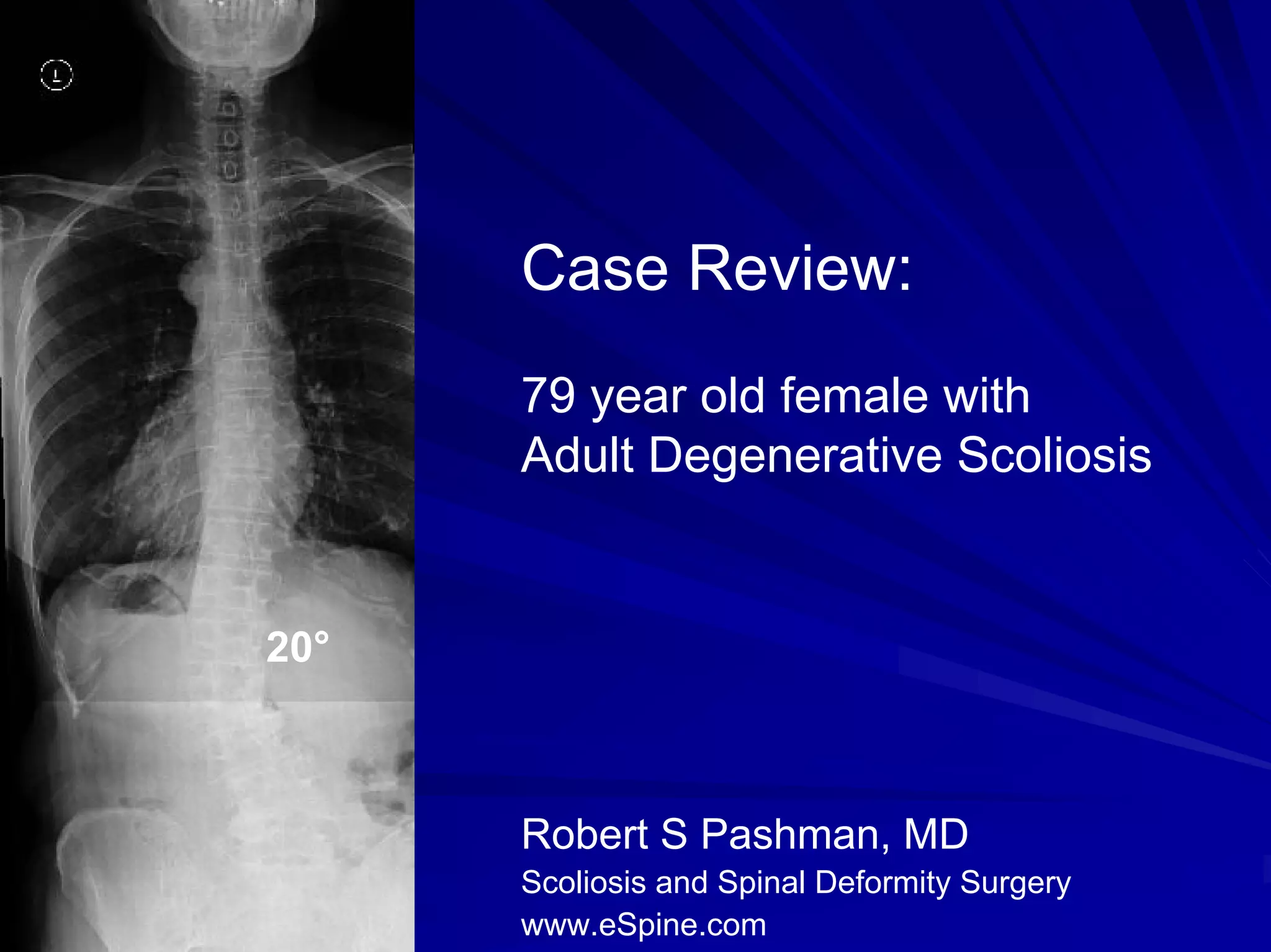 Case Review #18: 79 year old female with Degenerative scoliosis | PDF