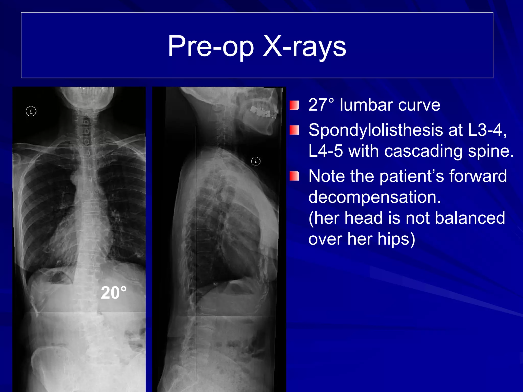 Case Review #18: 79 year old female with Degenerative scoliosis | PDF