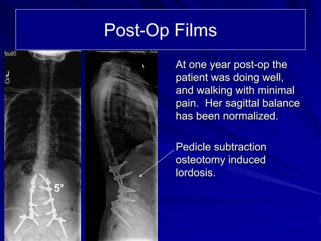 Case Review #18: 79 year old female with Degenerative scoliosis | PPT