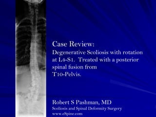 Case Review:
Degenerative Scoliosis with rotation
at L4-S1. Treated with a posterior
spinal fusion from
T10-Pelvis.



Robert S Pashman, MD
Scoliosis and Spinal Deformity Surgery
www.eSpine.com
 