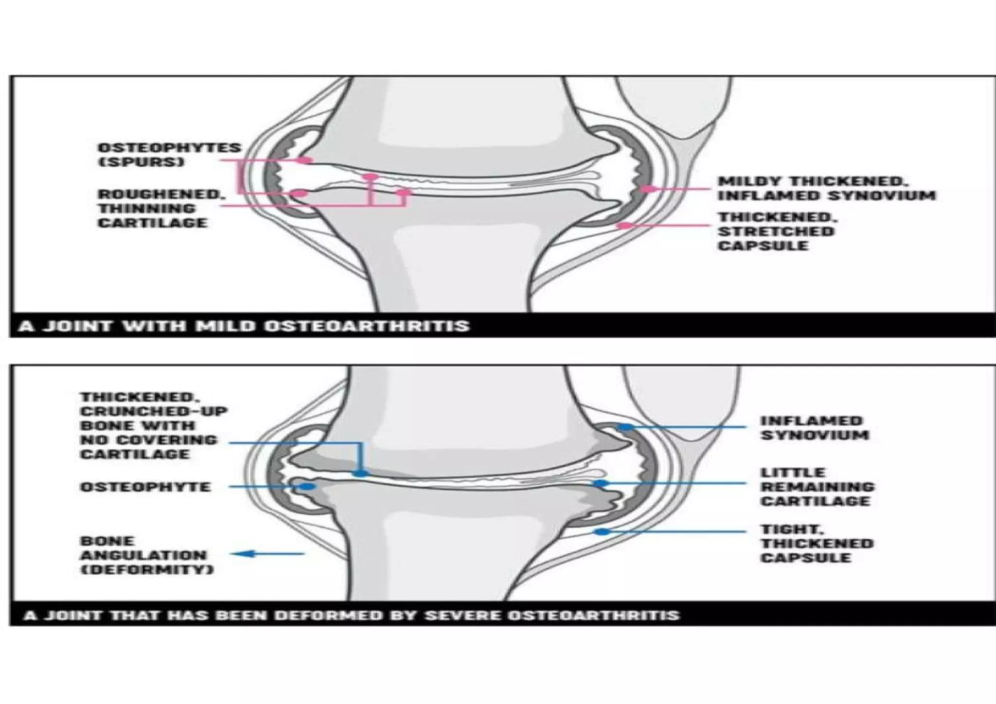 Degenerative condition of joints and spine For G.N.M 2nd & B.Sc.2nd ...