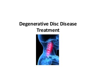 Degenerative Disc Disease
      Treatment
 
