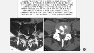 Comprehensive Overview of Degenerative Spine Diseases and Imaging ...