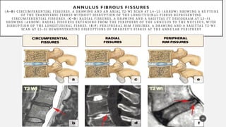 Comprehensive Overview of Degenerative Spine Diseases and Imaging ...