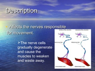 Description
• Affects the nerves responsible
for movement.

The nerve cells
gradually degenerate
and cause the
muscles to weaken
and waste away.

 